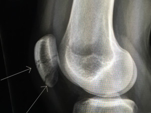 Fractured patella says slow down